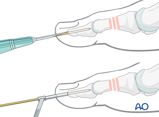 Axial K-wire insertion