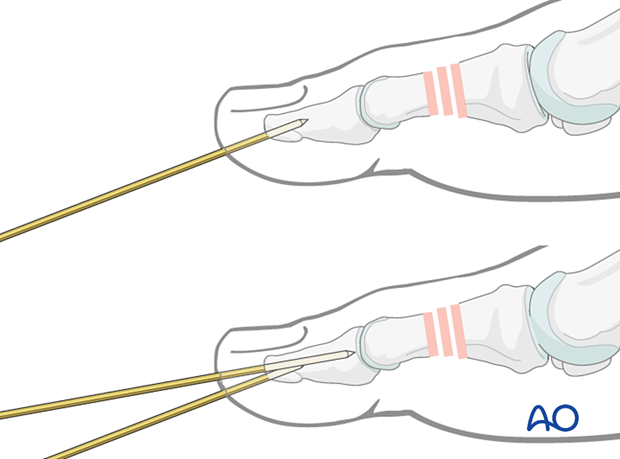 Axial K-wire insertion