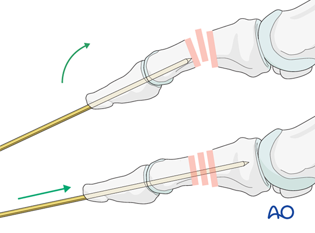 Axial K-wire insertion using outside-in technique