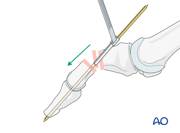 Axial K-wire insertion using inside out technique