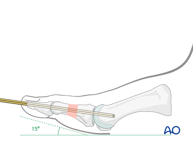 Passing K-wire across joint