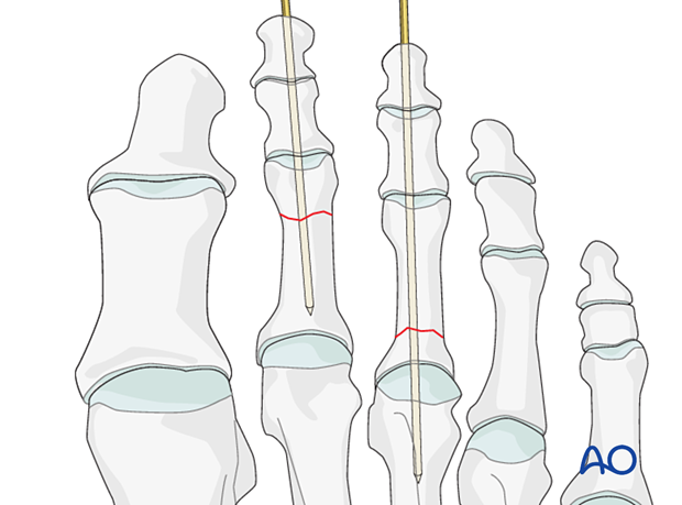 Axial wiring