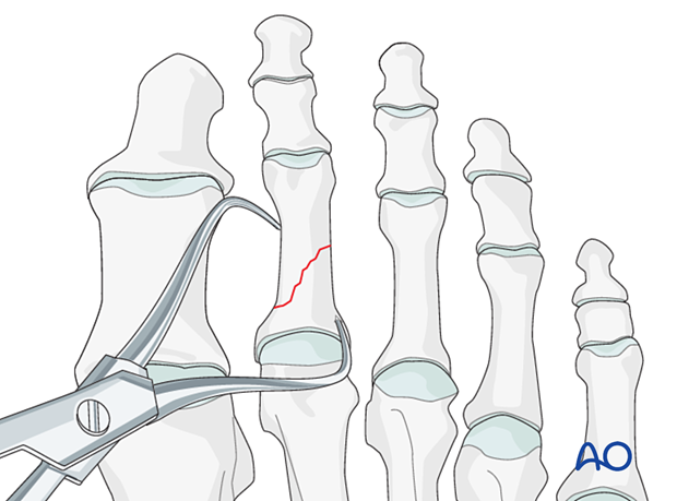 Reduction using a forceps