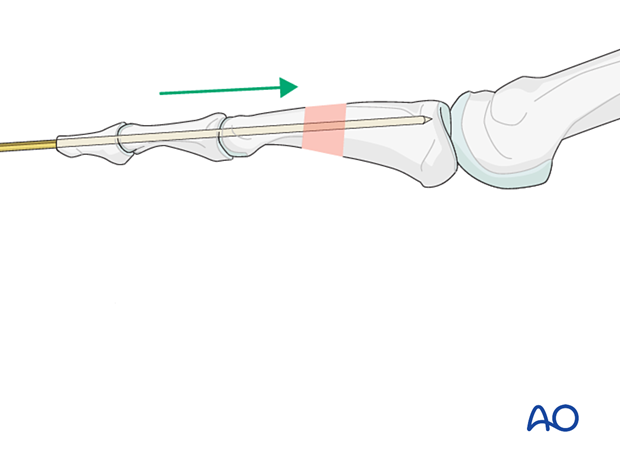 approach to the le fort i level of the midface in cleft lip and palate patients