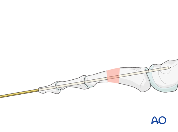 K-wire across MTP joint