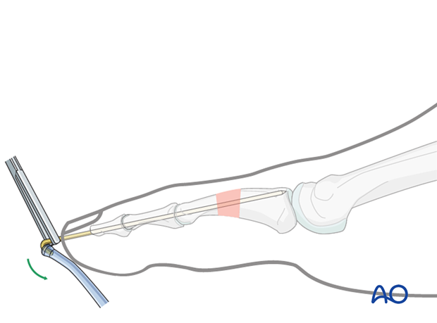 Bending of K-wire