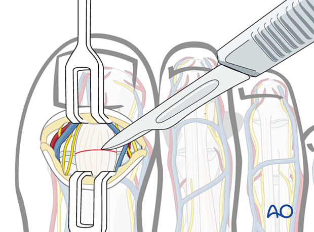 The extensor tendons are transected.