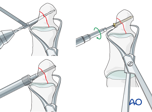 P230 Lag screw fixation