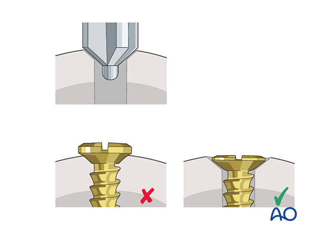 Countersinking