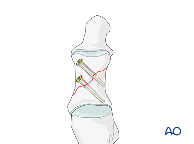 Final lag screw fixation with two screws