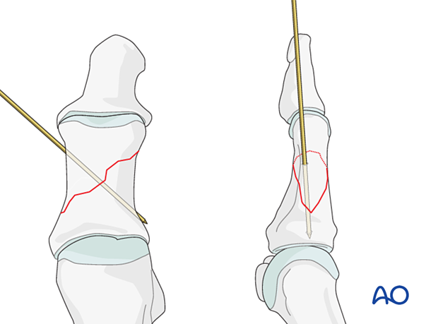 Preliminary fixation with K-wire