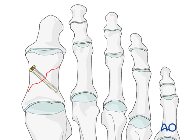 Lag screw fixation