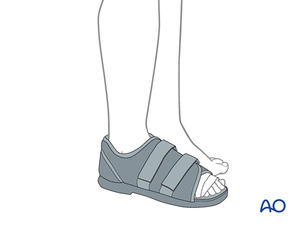 approach to the le fort i level of the midface in cleft lip and palate patients