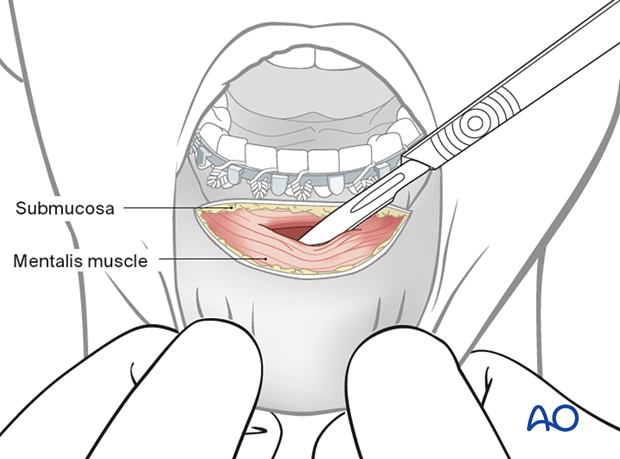 Bisection of the mentalis muscle