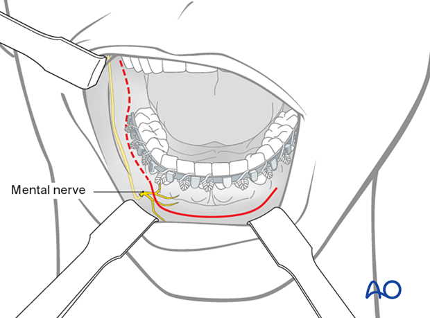 The transoral approach is the usual access for simple fractures of the body, symphysis, and angle regions.