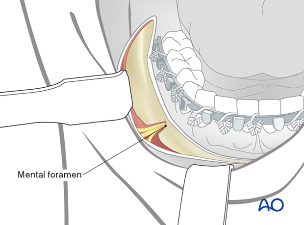 Dissection of the mental nerve