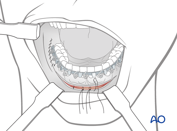 Closing the incision