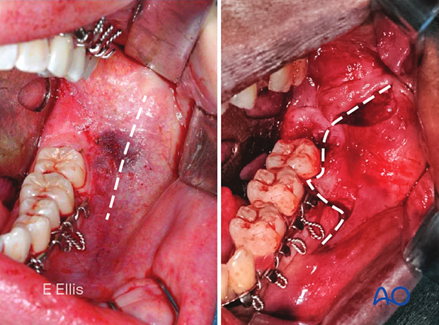 91 A011 transoral approach to the angle