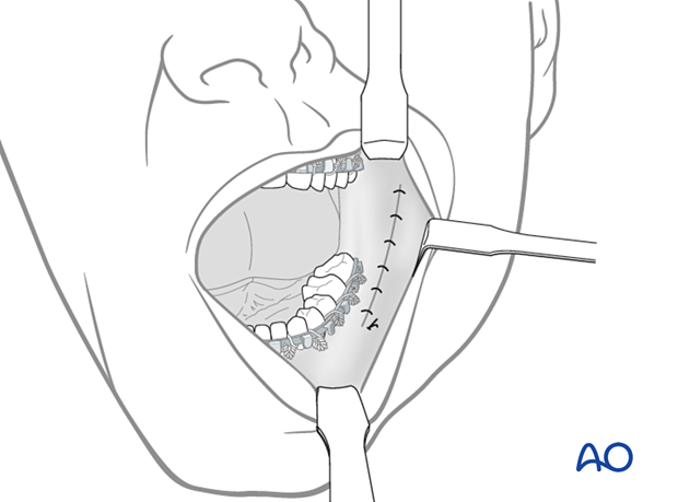 Closing the incision