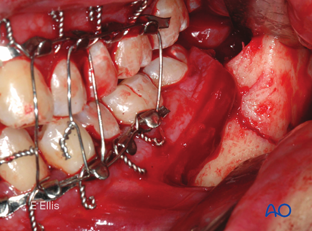 This clinical image shows the fracture exposed, reduced, and MMF secured