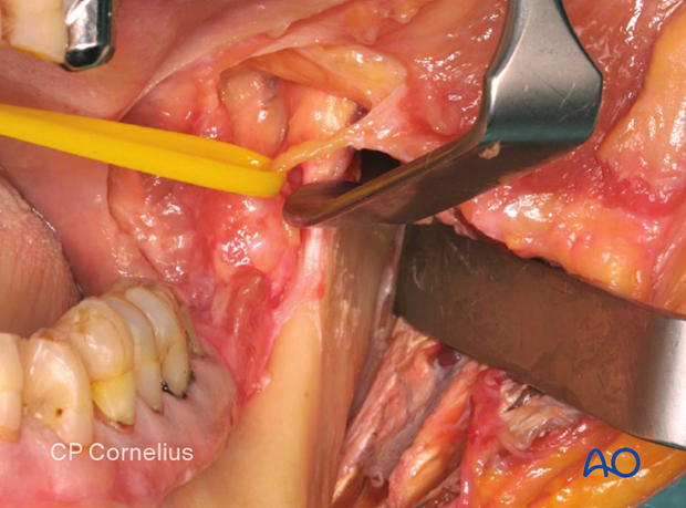 Photograph of the buccal sensory nerve