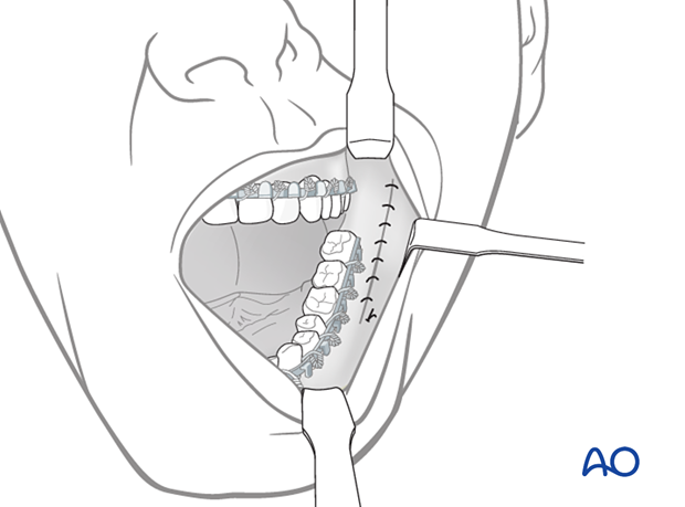 Closing the incision