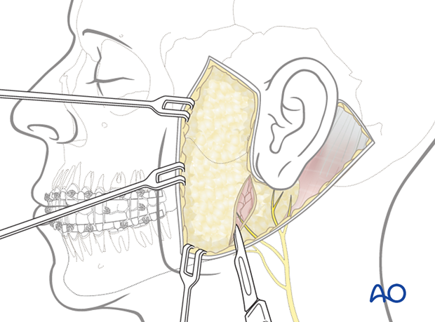 A vertical incision is made through SMAS