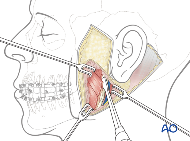 Strip the masseter muscle from the ramus