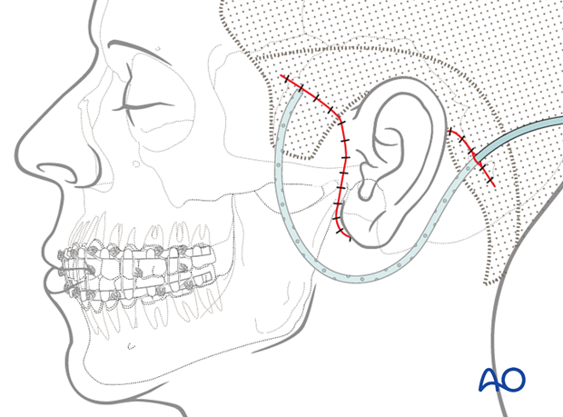 The skin and subcutaneous tissues are closed