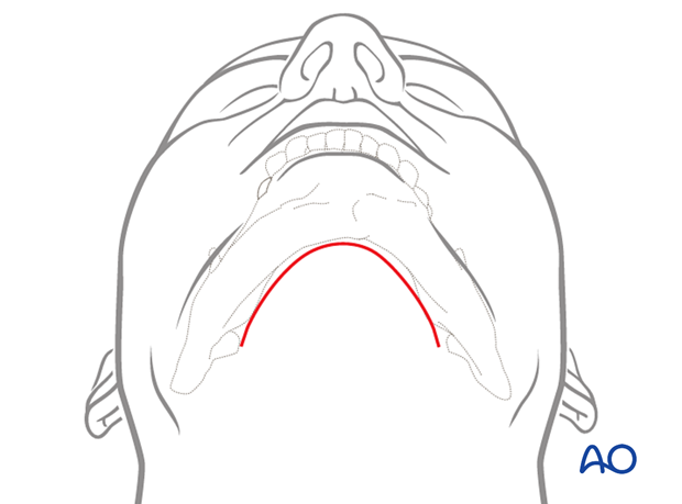 Incision lines for extended appraoch