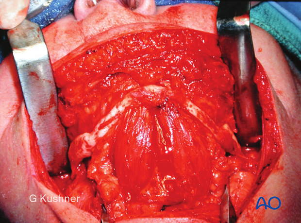 Exposed edentulous atrophic fractured mandible