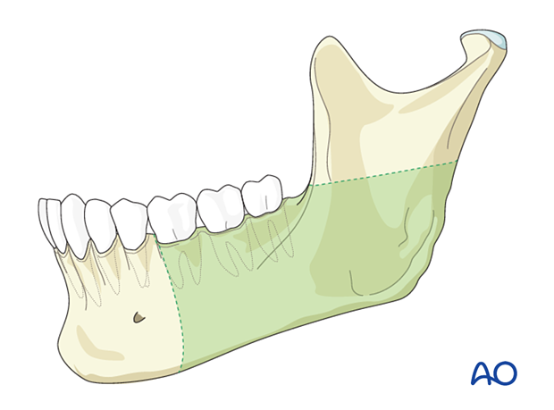 Exposure offered by the submandibular approach