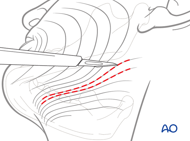 If using skin creases for the incision the orientation of the scalpel blade is parallel to the relaxed skin tension lines