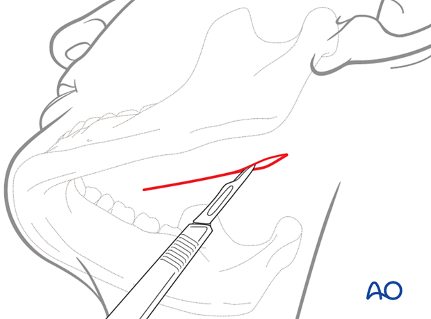 submandibular approach