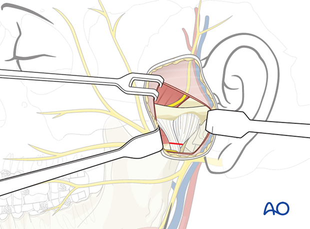 Incising the TMJ capsule