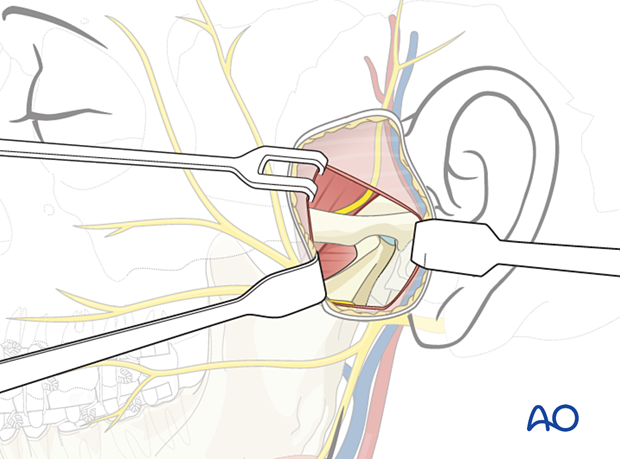 Preauricular approach