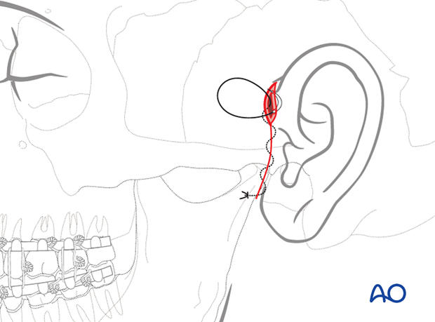 The temporalis fascia is closed