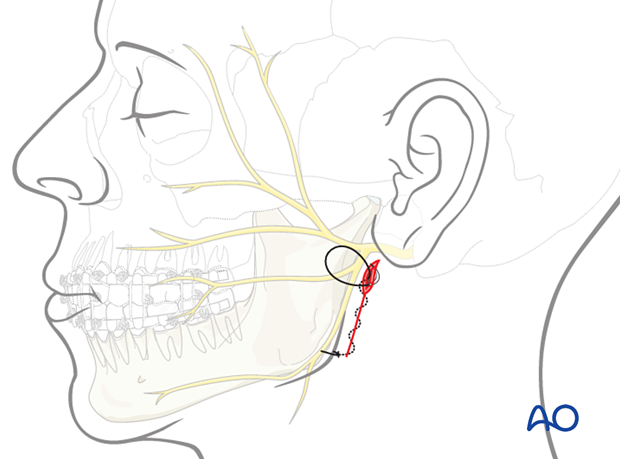 The skin and subcutaneous tissues are closed