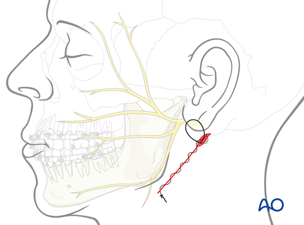 The wound is reapproximated in layers for anatomic realignment