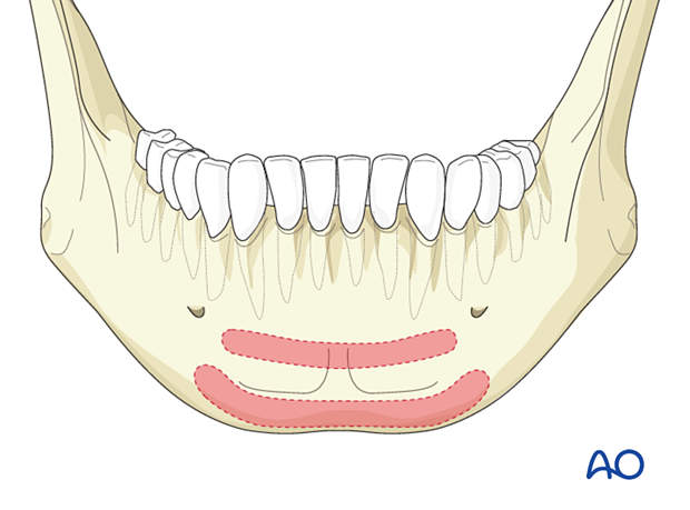 The illustration shows Champy's ideal lines of osteosynthesis for symphysis fractures.