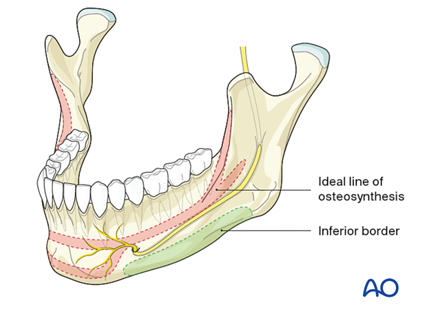 ideal line of osteosynthesis in the body region 