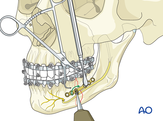 Insertion of first screw