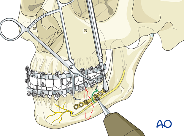 Insertion of second screw