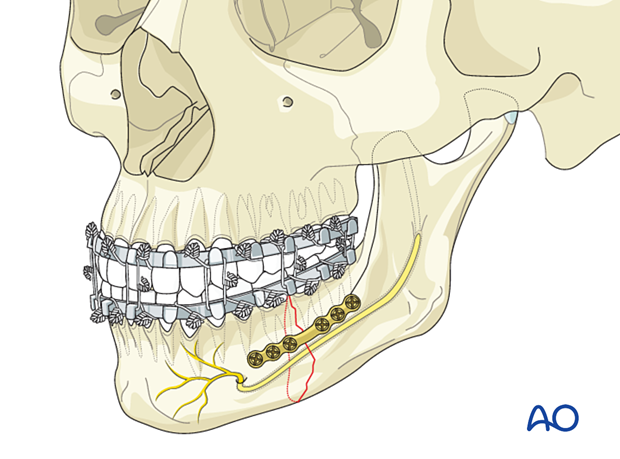 Additional screw insertion