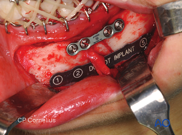 Plate contouring of lower border plate