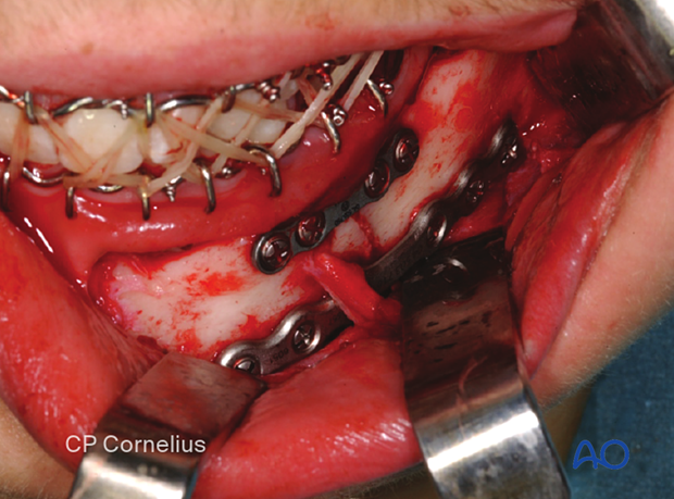 Plate insertion of lower border plate