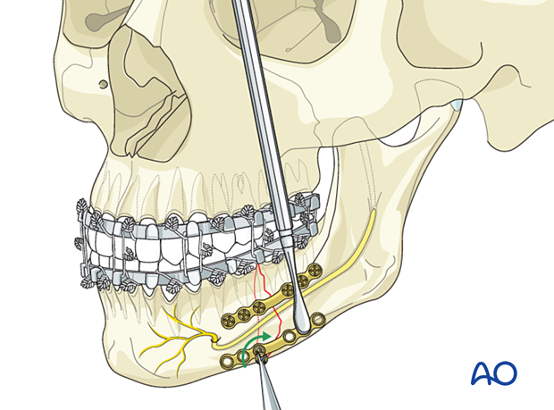 Insertion of screw in lower border plate