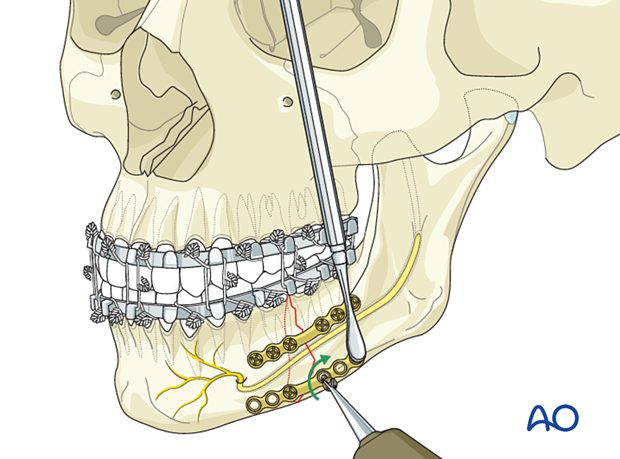 Insertion of second screw in lower border plate