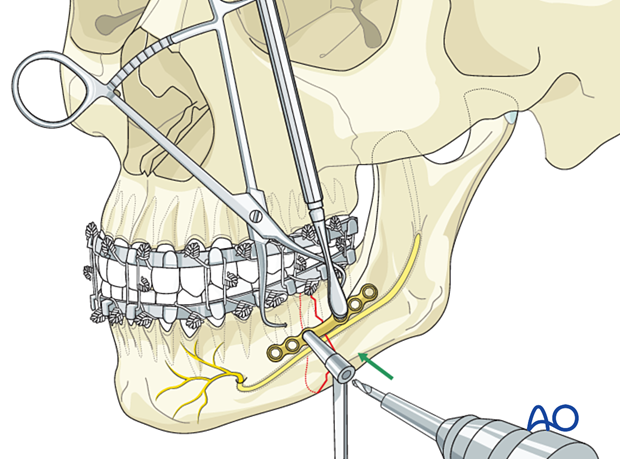 Drillig of the first screw hole