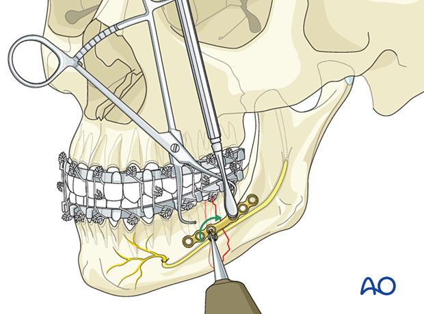 Insertion of the first screw